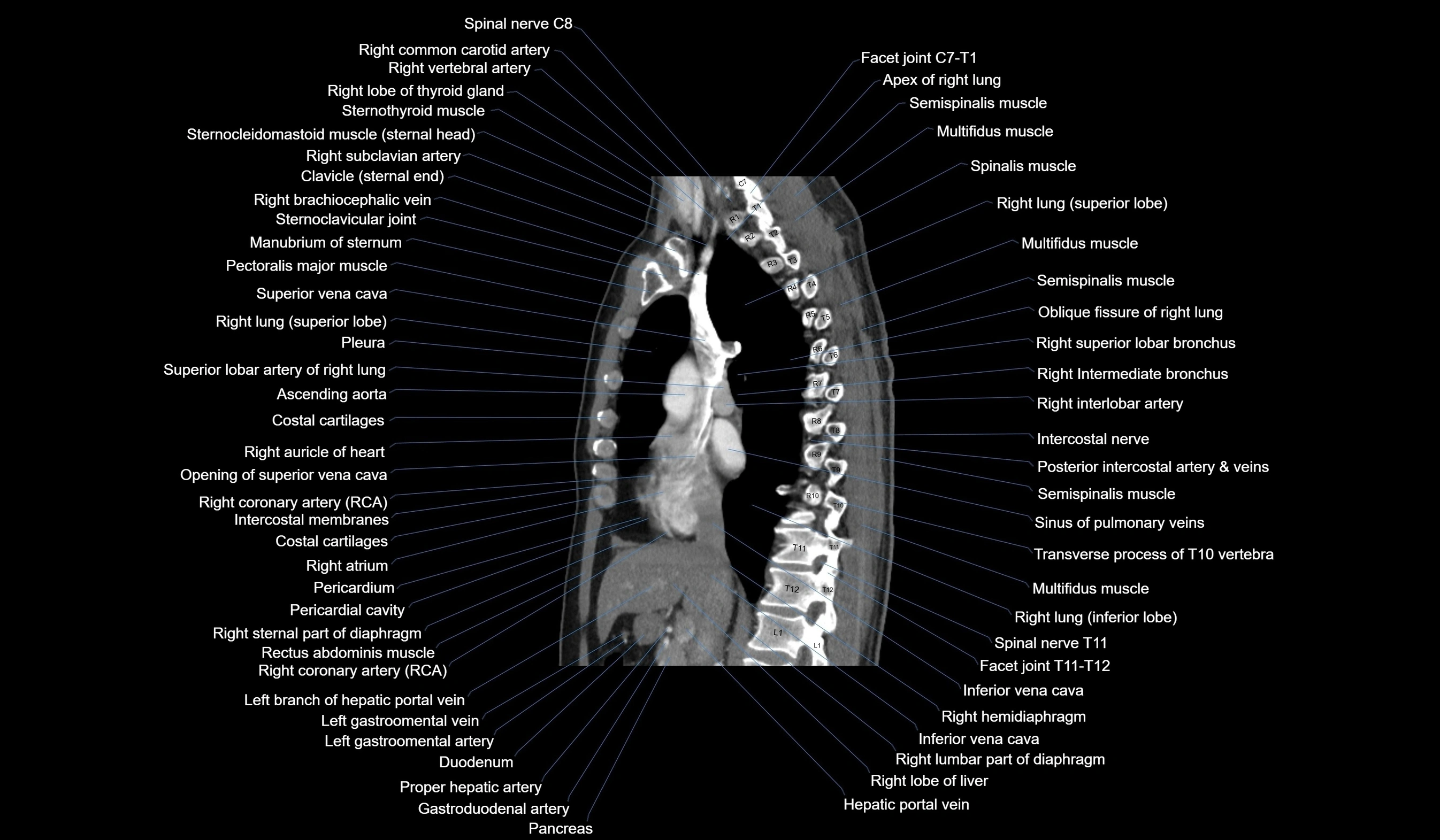 CT chest (thorax) soft tissue window labelled sagittal cross sectional anatomy radiology image-00065.webp